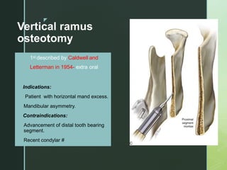 z
Vertical ramus
osteotomy
• 1st described by Caldwell and
 Letterman in 1954- extra oral
 Indications:
 Patient with horizontal mand excess.
 Mandibular asymmetry.
 Contraindications:
 Advancement of distal tooth bearing
segment.
 Recent condylar #
 