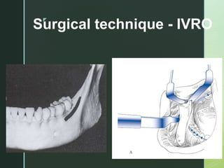 z
Surgical technique - IVRO
 