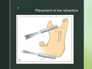 z
Placement of the retractors
 