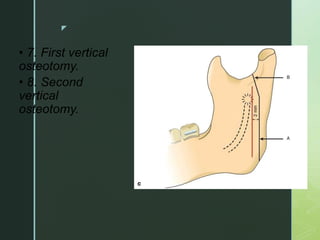 z
• 7. First vertical
osteotomy.
• 8. Second
vertical
osteotomy.
 