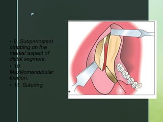 z
• 9. Subperiosteal
stripping on the
medial aspect of
distal segment.
• 10.
Maxillomandibular
fixation.
• 11. Suturing
 