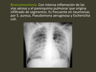 Bronconeumonia Con intensa inflamación de las
vías aéreas y el parenquima pulmonar que origina
infiltrado de segmentos. Es frecuente en neumonias
por S. aureus, Pseudomona aeruginosa y Escherichia
coli.
 