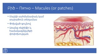 Բիծ – Пятно – Macules (or patches)
• Մաշկի սահմանափակ կամ
տարածուն տեղամաս
• Փոխված գույնով
• Առանց ռելիեֆի և
համակազմվածքի
փոփոխության
 