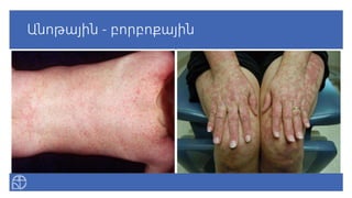 Անոթային - բորբոքային
 