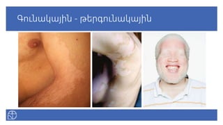 Գունակային - թերգունակային
 