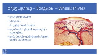 Եղնջայտուց – Волдырь – Wheals (hives)
• սուր բորբոքային
• Անխոռոչ
• մաշկից բարձրադիր
• գոյանում է շճային այտուցից -
սպոնգիոզ
• բուն մաշկի պտկիկային շերտի
վերին մասերում:
 