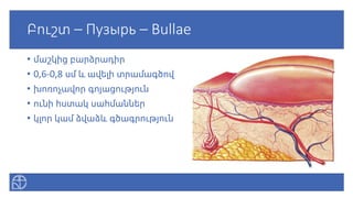Բուշտ – Пузырь – Bullae
• մաշկից բարձրադիր
• 0,6-0,8 սմ և ավելի տրամագծով
• խոռոչավոր գոյացություն
• ունի հստակ սահմաններ
• կլոր կամ ձվաձև գծագրություն
 