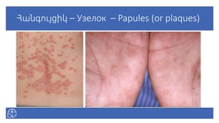 Հանգույցիկ – Узелок – Papules (or plaques)
 