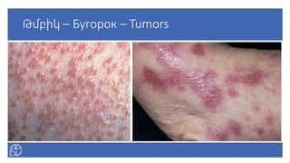 Թմբիկ – Бугорок – Tumors
 
