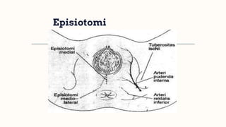Episiotomi
 