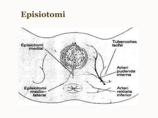 Episiotomi
 