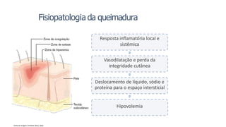 Resposta inflamatória local e
sistêmica
Vasodilatação e perda da
integridade cutânea
Deslocamento de líquido, sódio e
proteína para o espaço intersticial
Hipovolemia
Fonte da imagem: Smeltzer;Bare, 2016
Fisiopatologia da queimadura
 