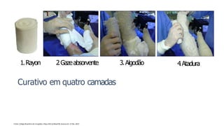 Curativo em quatro camadas
1.Rayon 2
.Gazeabsorvente 3.Algodão 4
.Atadura
Fonte: Colégio Brasileiro de Cirurgiões. https://bit.ly/36xeVh8. Acesso em: 21 Ma. 2022
 