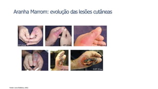 Aranha Marrom: evolução das lesões cutâneas
Fonte: Livro Didático, U4S1.
 