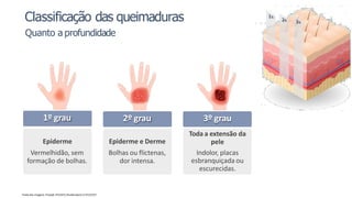 1º grau
Epiderme
Vermelhidão, sem
formação de bolhas.
2º grau
Epiderme e Derme
Bolhas ou flictenas,
dor intensa.
3º grau
Toda a extensão da
pele
Indolor, placas
esbranquiçada ou
escurecidas.
Fonte das imagens: Freepik 7552472;Shutterstock 1175115757
Classificação das queimaduras
Quanto a profundidade
 