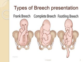 Types of Breech presentation
1/16/2024 8
 