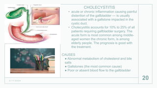 CHOLECYSTITIS
• acute or chronic inflammation causing painful
distention of the gallbladder — is usually
associated with a gallstone impacted in the
cystic duct.
• Cholecystitis accounts for 10% to 25% of all
patients requiring gallbladder surgery. The
acute form is most common among middle-
aged women the chronic form, is among
elderly people. The prognosis is good with
the treatment.
CAUSES
● Abnormal metabolism of cholesterol and bile
salts
● Gallstones (the most common cause)
● Poor or absent blood flow to the gallbladder
2 / 1 1 / 2 0 2 4
20
 