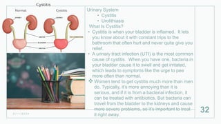 Urinary System
• Cystitis
• Urolithiasis
What Is Cystitis?
• Cystitis is when your bladder is inflamed. It lets
you know about it with constant trips to the
bathroom that often hurt and never quite give you
relief.
• A urinary tract infection (UTI) is the most common
cause of cystitis. When you have one, bacteria in
your bladder cause it to swell and get irritated,
which leads to symptoms like the urge to pee
more often than normal.
Women tend to get cystitis much more than men
do. Typically, it’s more annoying than it is
serious, and if it is from a bacterial infection, it
can be treated with antibiotics. But bacteria can
travel from the bladder to the kidneys and cause
more severe problems, so it’s important to treat
it right away.
2 / 1 1 / 2 0 2 4
32
 