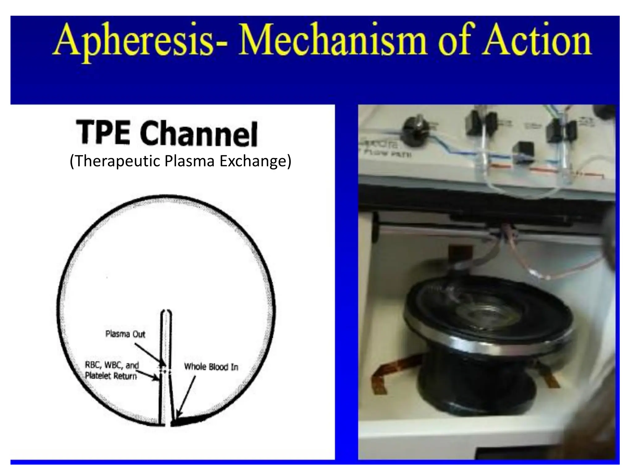 (Therapeutic Plasma Exchange)
 