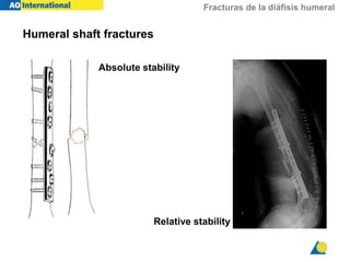 11.-Fx_humero para desarrollar traumato.ppt