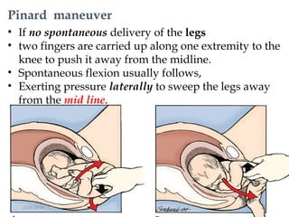 Pinard maneuver
• If no spontaneous delivery of the legs
• two fingers are carried up along one extremity to the
knee to push it away from the midline.
• Spontaneous flexion usually follows,
• Exerting pressure laterally to sweep the legs away
from the mid line.
2/23/2016 28
 