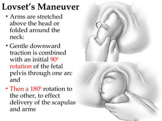 32
Lovset’s Maneuver
• Arms are stretched
above the head or
folded around the
neck:
• Gentle downward
traction is combined
with an initial 900
rotation of the fetal
pelvis through one arc
and
• Then a 1800
rotation to
the other, to effect
delivery of the scapulas
and arms
 