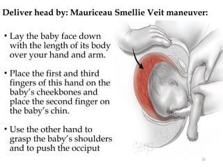 Deliver head by: Mauriceau Smellie Veit maneuver:
35
• Lay the baby face down
with the length of its body
over your hand and arm.
• Place the first and third
fingers of this hand on the
baby’s cheekbones and
place the second finger on
the baby’s chin.
• Use the other hand to
grasp the baby’s shoulders
and to push the occiput
 