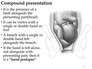 Compound presentation
66
• It is the presence of a
limb alongside the
presenting part(head)
• It can be vertex with a
single or double hand or
feet
• A breech with a single or
double hand felt
alongside the breech.
• If the hand is felt alone,
not alongside with
presenting part, then it
is a “hand prolapse”
 