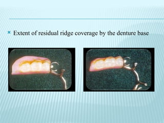 11.Special Impression Procedures For TooTH-Tissue-Supported removable ...