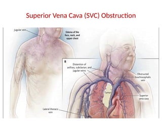 Svc. Sign Lung Tumours, classification and its pathology | PPTX