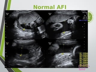 11. Amniotic fluid Disorders in pregnancy | PDF