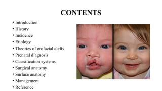 management of Cleft Lip, management of cleft lip and palate | PPTX