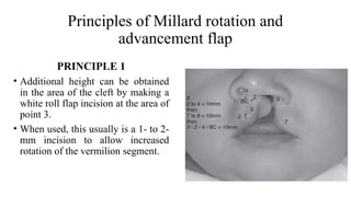 management of Cleft Lip, management of cleft lip and palate | PPTX