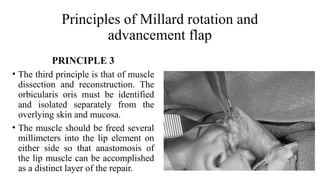 management of Cleft Lip, management of cleft lip and palate | PPTX