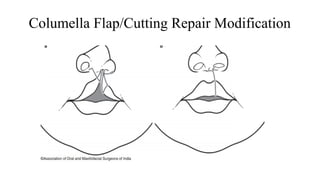 management of Cleft Lip, management of cleft lip and palate | PPTX