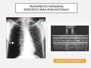 TRATAMENTO HIPOXEMIA:
ESPECÍFICO PARA PNEUMOTÓRAX
PILARES DO TRATAMENTO
 