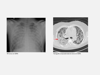 RX tórax em SDRA Tomografia computadorizada de tórax em SDRA
 