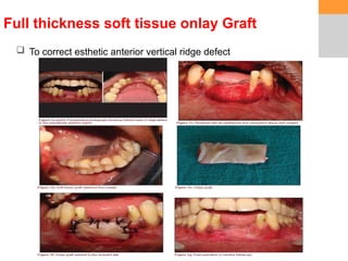 Siberet Ridge Defect 1 soft tissue ridge augmentation e1.pptx