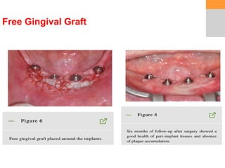 1 soft tissue ridge augmentation e1.pptx