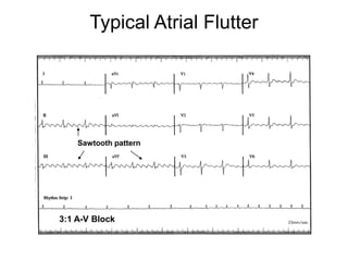 Typical Atrial Flutter




         Sawtooth pattern




     3:1 A-V Block


11
 