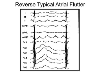 Reverse Typical Atrial Flutter




13
 
