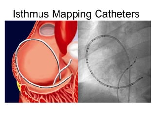 Isthmus Mapping Catheters




16
 