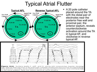 Typical Atrial Flutter
     Typical AFL       Reverse Typical AFL    A 20 pole catheter
                                               placed around the TA
                                               with the distal pair of
                                               electrodes near the
                                               posterior free wall and
                                               proximal pair, the
                                               anterior septum, reveals
                                               counterclockwise
                                               activation around the TA
                                               in typical AF, and
                                               clockwise in reverse
                                               typical AF.




17
 