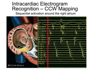 Intracardiac Electrogram
     Recognition – CCW Mapping
      Sequential activation around the right atrium




20
 