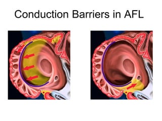 Conduction Barriers in AFL




22
 