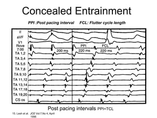Concealed Entrainment
                 PPI :Post pacing interval     FCL: Flutter cycle length




                                  Post pacing intervals PPI=TCL
23 15. Lesh et al. JCE Vol.7,No 4, April
                   1996
 