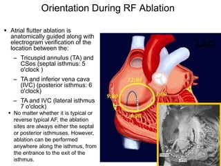 Orientation During RF Ablation

 Atrial flutter ablation is
  anatomically guided along with
  electrogram verification of the              LAO
  location between the:
   – Tricuspid annulus (TA) and
     CSos (septal isthmus: 5
     o'clock )
   – TA and inferior vena cava
     (IVC) (posterior isthmus: 6
     o'clock)
   – TA and IVC (lateral isthmus
     7 o'clock)
  No matter whether it is typical or
   reverse typical AF, the ablation
   sites are always either the septal
   or posterior isthmuses. However,
   ablation can be performed
   anywhere along the isthmus, from
   the entrance to the exit of the
 31isthmus.
 