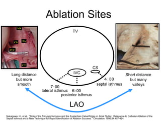 Ablation Sites
                                                               TV




                                                                                  CS
    Long distance                                               IVC                                  Short distance
      but more                                                                            ４：３0         but many
       smooth                                                                         septal isthmus    valleys
                                      7：00
                                 lateral isthmus 6：00
                                             posterior isthmus

                                                            LAO
32
Nakagawa. H., et al., “Role of the Tricuspid Annulus and the Eustachian Valve/Ridge on Atrial Flutter: Relevance to Catheter Ablation of the
Septal Isthmus and a New Technique for Rapid Identification of Ablation Success.” Circulation. 1996;94:407-424.
 
