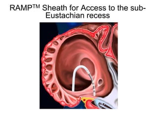 RAMPTM Sheath for Access to the sub-
         Eustachian recess




34
 