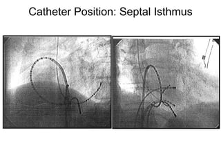 Catheter Position: Septal Isthmus




35
 